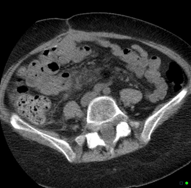 File:Obstructed infected horseshoe kidney (Radiopaedia 18116-17898 non-contrast 26).jpg