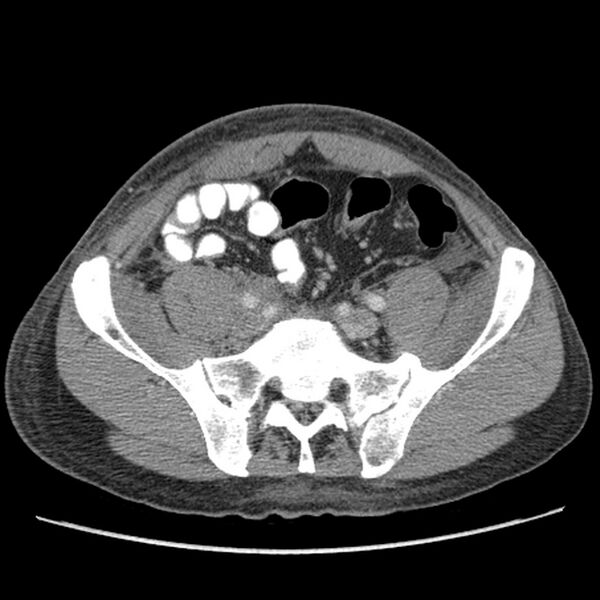File:Obstructive bladder transitional cell carcinoma (Radiopaedia 9825-10410 A 22).jpg