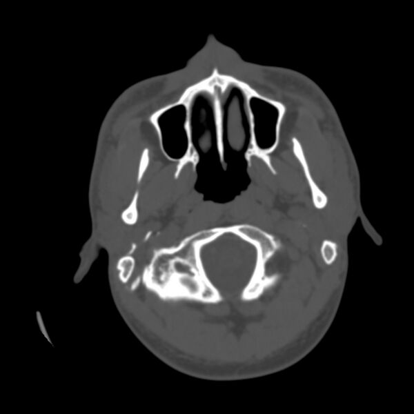 File:Occipital spur - asymptomatic (Radiopaedia 87753-104201 Axial bone window 1).jpg