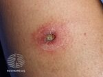See more images of ecthyma. (DermNet NZ bacterial-ecthyma-9).jpg