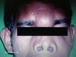 Mucormycosis skin of forehead.[29]