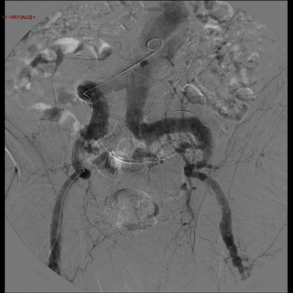 File:Abdominal aortic aneurysm (Radiopaedia 16155-15833 Frontal Aorta 13).jpg