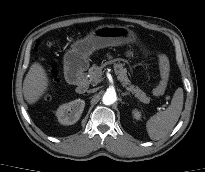 File:Abdominal aortic aneurysm (Radiopaedia 22421-22458 C+ arterial phase 20).jpg