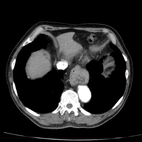File:Abdominal aortic aneurysm (Radiopaedia 29248-29660 Axial C+ arterial phase 7).jpg