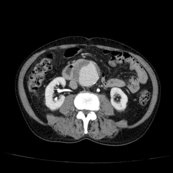 File:Abdominal aortic aneurysm (Radiopaedia 29248-29660 Axial C+ portal venous phase 31).jpg