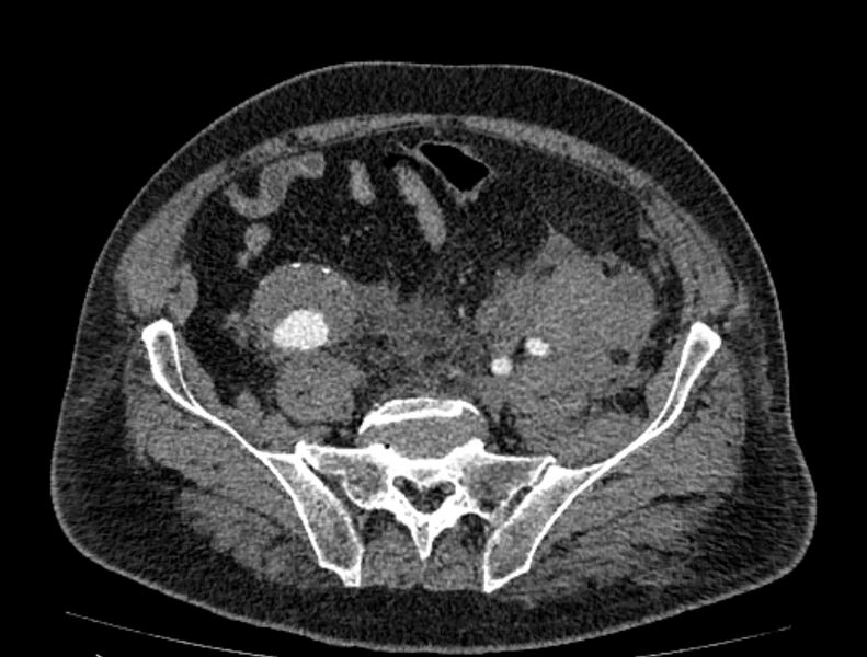File:Abdominal aortic aneurysm rupture (Radiopaedia 54179-60362 Axial C+ portal venous phase 9).jpg