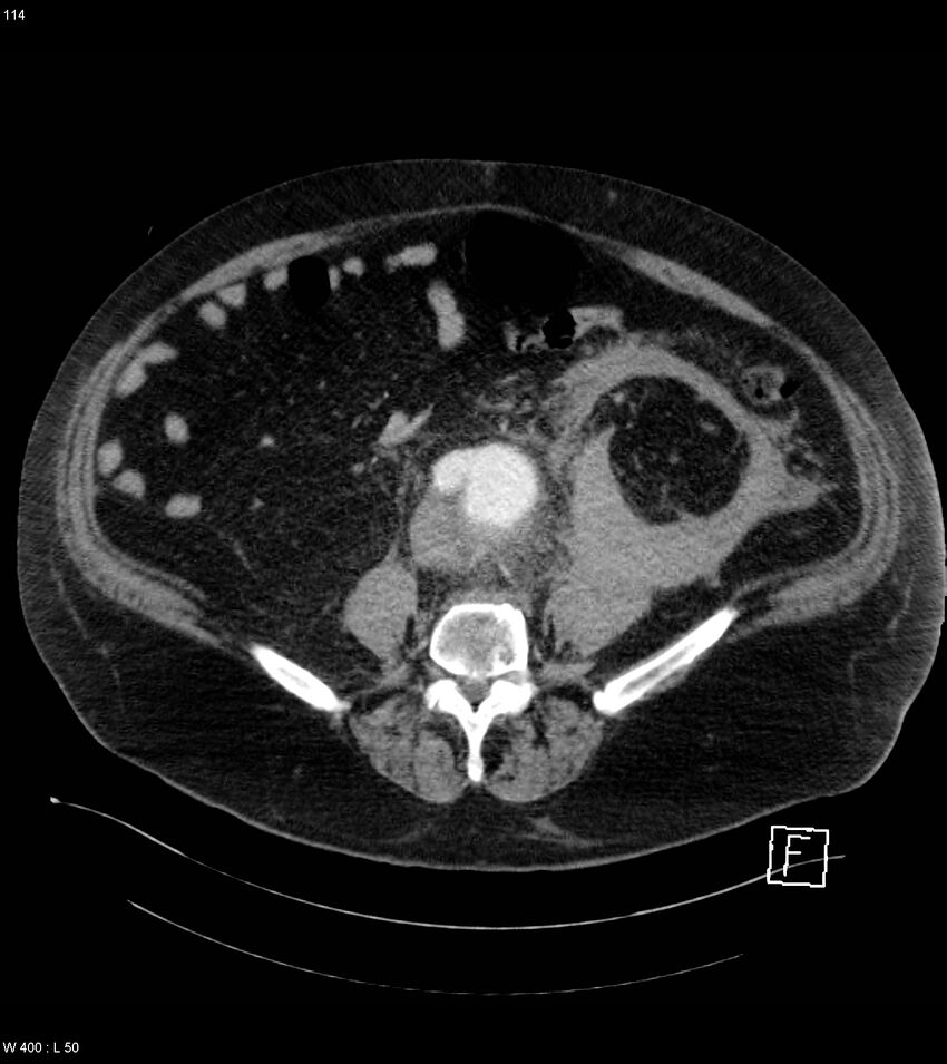 Abdominal aortic aneurysm with intramural hematoma then rupture (Radiopaedia 50278-55632 Axial C+ arterial phase 113).jpg