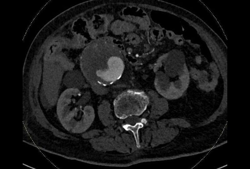 File:Abdominal aortic aneurysm with thrombus fissuration (Radiopaedia 73192-83919 Axial C+ arterial phase 94).jpg