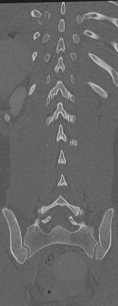 File:Abdominal multi-trauma - devascularised kidney and liver, spleen and pancreatic lacerations (Radiopaedia 34984-36486 Coronal bone window 52).png
