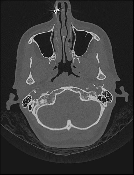 File:Aberrant right internal carotid artery (Radiopaedia 65191-74198 Axial non-contrast 16).jpg