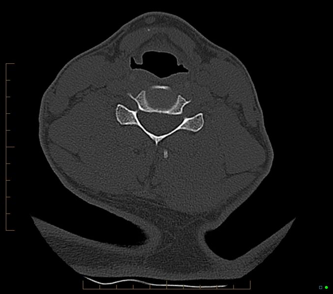 File:Accessory articulation of cervical transverse processes (Radiopaedia 82715-96933 Axial non-contrast 80).jpg