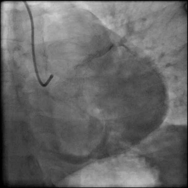 File:Acute anteroseptal myocardial infarction (Radiopaedia 68409-77946 LAO caudal (spider view) LAD and CX 81).jpg