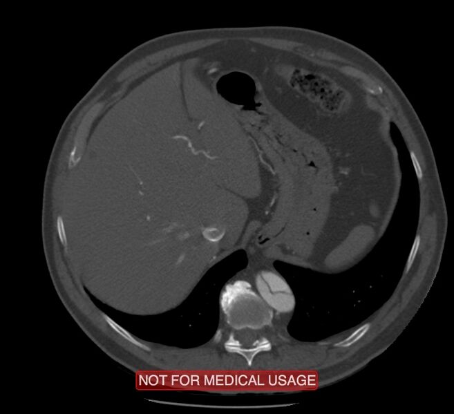 File:Acute aortic dissection - Stanford type A (Radiopaedia 40661-43285 Axial C+ arterial phase 71).jpg