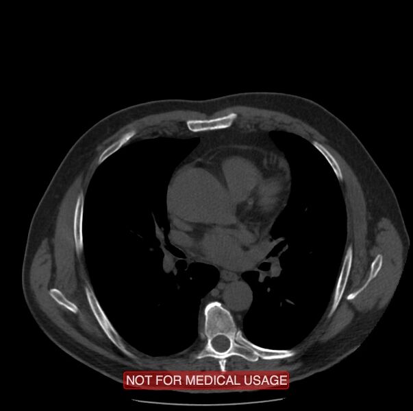 File:Acute aortic dissection - Stanford type A (Radiopaedia 40661-43285 Axial non-contrast 30).jpg