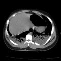 Acute aspiration pneumonitis (Radiopaedia 33605-34703 Axial non-contrast 70).jpg