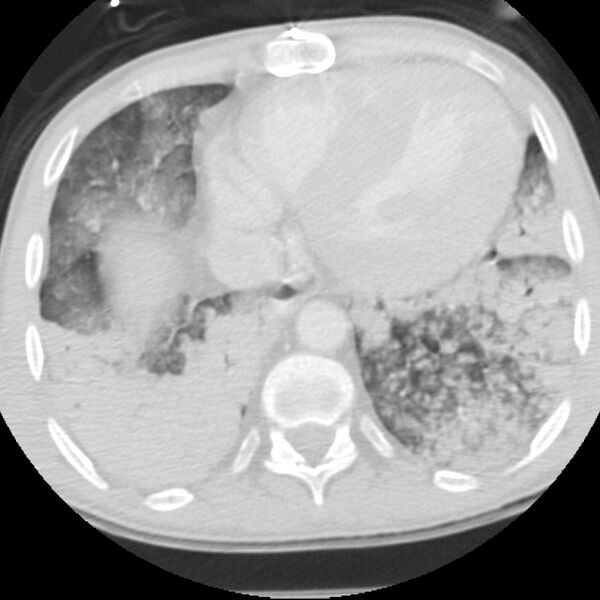 File:Acute diffuse alveolar hemorrhage (Radiopaedia 41323-44158 Axial lung window 48).jpg