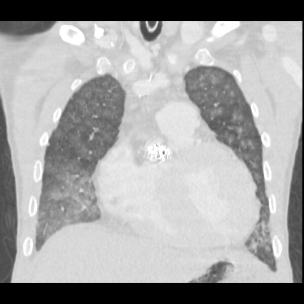 File:Acute diffuse alveolar hemorrhage (Radiopaedia 41323-44158 Coronal lung window 12).jpg