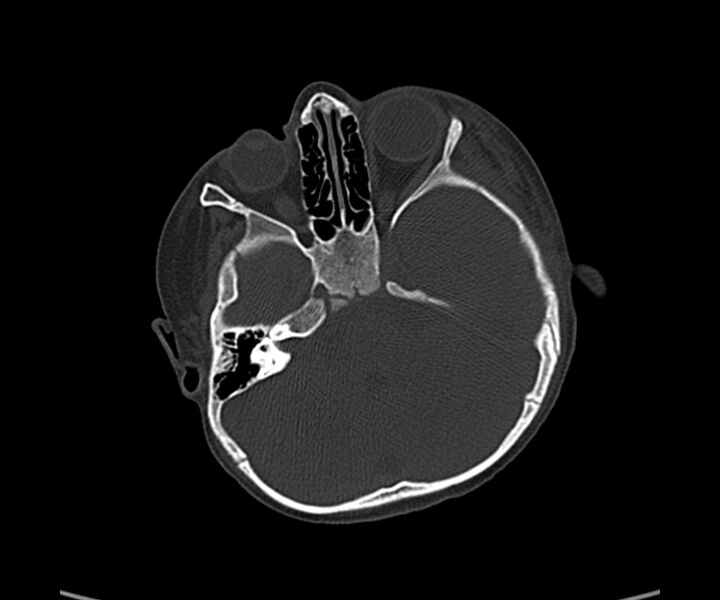 File:Acute hemorrhagic contusion (Radiopaedia 63660-72336 Axial bone window 19).jpg