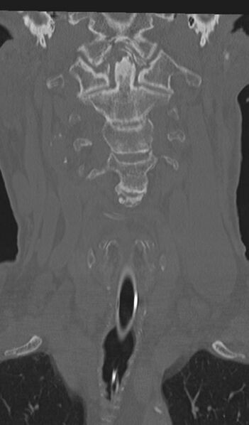 File:Acute on chronic subdural hematoma and thoracic vertebral injury in a multitrauma patient (Radiopaedia 31698-32619 Coronal bone window 15).jpg