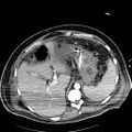 Acute pancreatic necrosis (Radiopaedia 13560-18502 Axial C+ portal venous phase 7).jpg