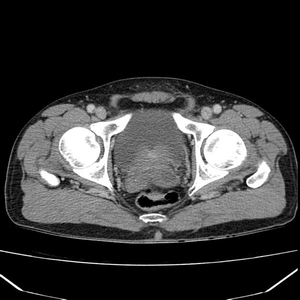 File:Acute pancreatitis (Radiopaedia 22572-22596 Axial C+ portal venous phase 70).jpg