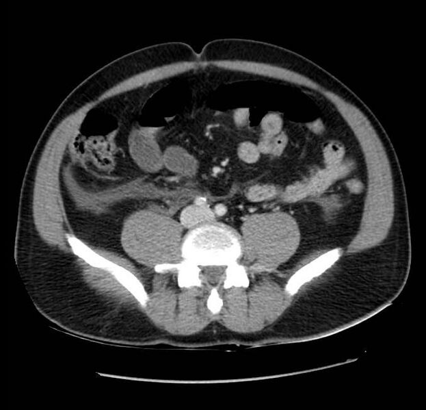 File:Acute pancreatitis - Balthazar E (Radiopaedia 23080-23110 Axial C+ portal venous phase 45).jpg