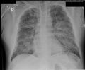 Acute pulmonary edema (Radiopaedia 66373).jpg