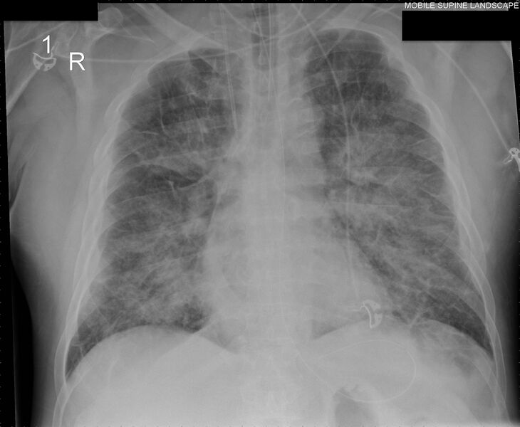 File:Acute pulmonary edema (Radiopaedia 66373).jpg