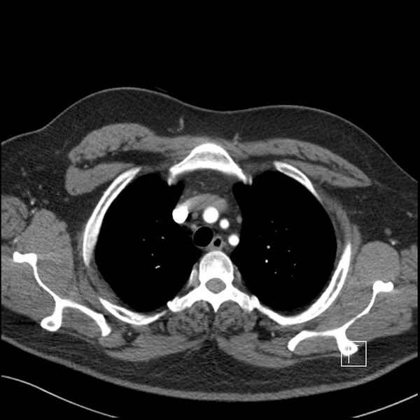 File:Acute pulmonary embolism with pulmonary infarct (Radiopaedia 73062-83768 Axial C+ CTPA 13).jpg