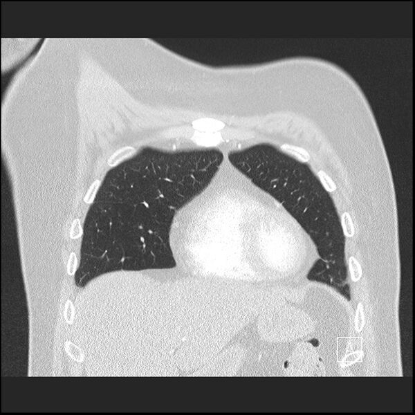 File:Acute pulmonary embolism with pulmonary infarct (Radiopaedia 73062-83768 Coronal lung window 17).jpg