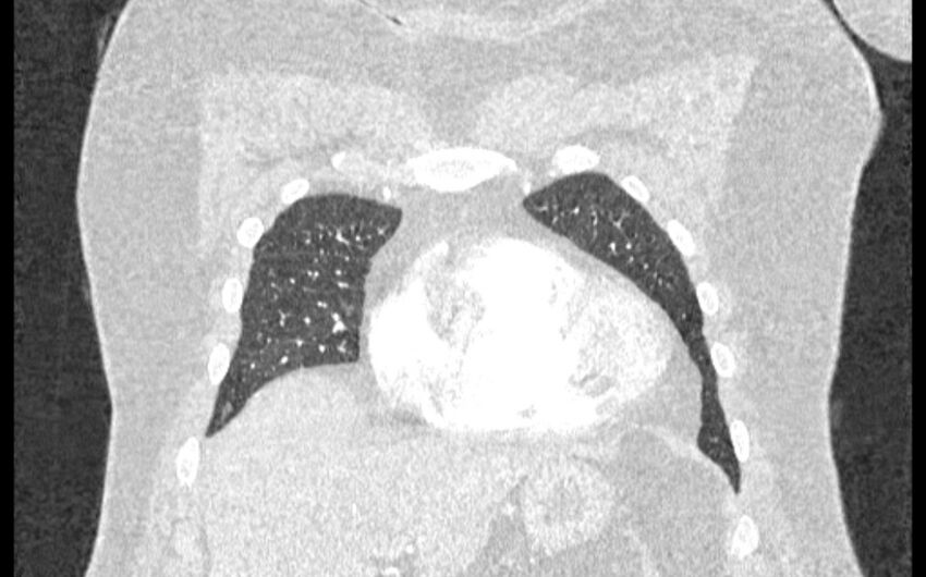 Acute pulmonary embolism with pulmonary infarcts (Radiopaedia 77688-89908 Coronal lung window 9).jpg