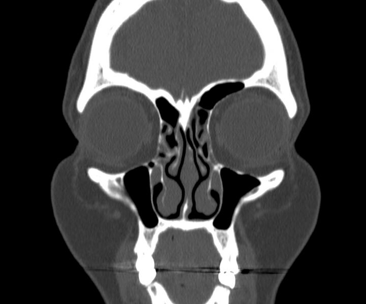 File:Acute sinusitis (Radiopaedia 22419-22455 Coronal bone window 10).jpg