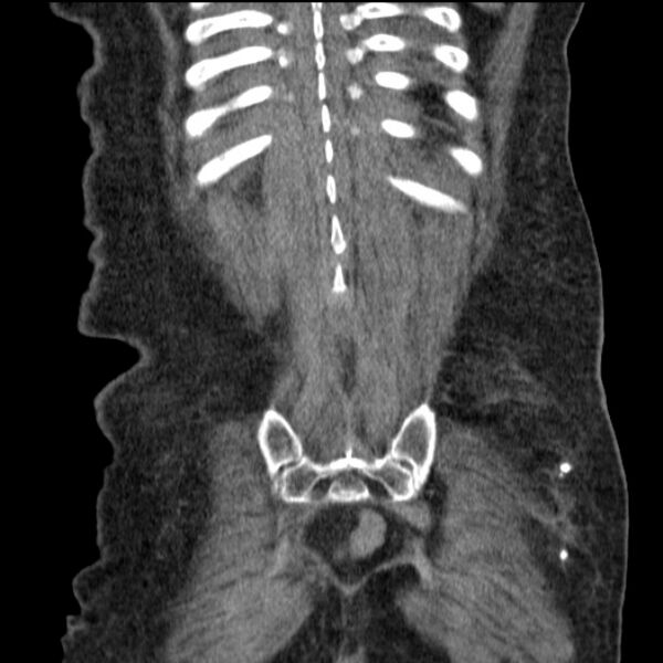 File:Acute tubular necrosis (Radiopaedia 28077-28334 D 72).jpg