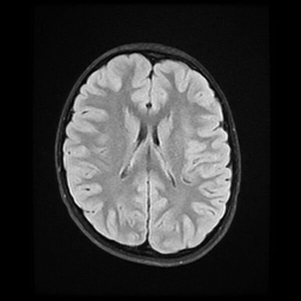 File:Adamantinomatous craniopharyngioma (Radiopaedia 77407-89529 Axial FLAIR 16).jpg