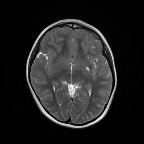 File:Adamantinomatous craniopharyngioma (Radiopaedia 77407-89529 Axial T2 12).jpg