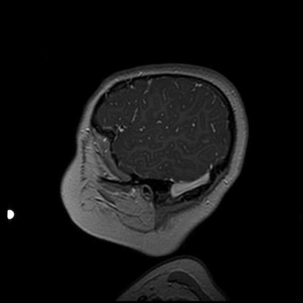 File:Adamantinomatous craniopharyngioma (Radiopaedia 77407-89529 H 17).jpg