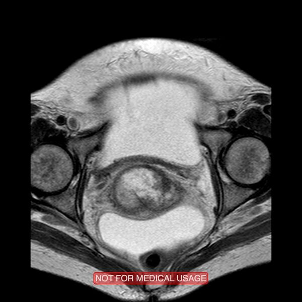 File:Adenocarcinoma of the cervix (Radiopaedia 28373-28615 Axial T2 7).jpg