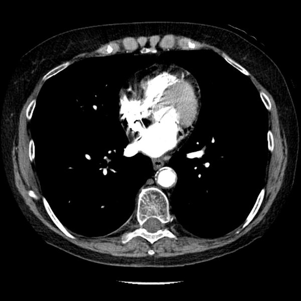 File:Adenocarcinoma of the lung (Radiopaedia 41015-43755 Axial C+ portal venous phase 75).jpg