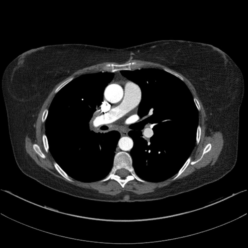 Adenocarcinoma of the lung (Radiopaedia 44205-47803 Axial C+ portal venous phase 41).jpg