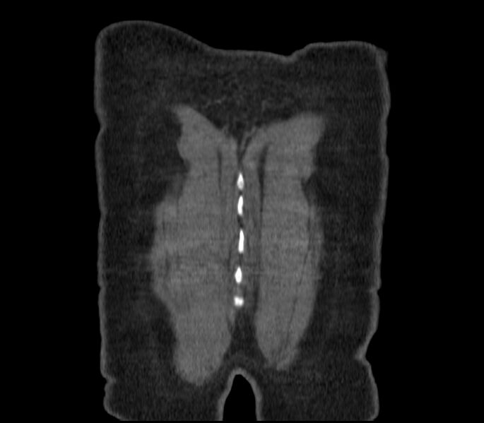 File:Adenocarcinoma of the lung (Radiopaedia 44205-47803 Coronal C+ portal venous phase 98).jpg