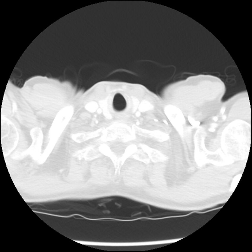Adenocarcinoma of the lung - micropapillary predominant (Radiopaedia 42446-45563 Axial lung window 2).jpg