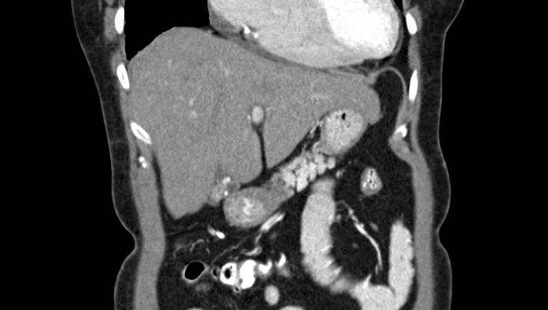 File:Adenomyomatosis of the gallbladder (Radiopaedia 12142-12483 Coronal C+ arterial phase 10).jpg