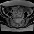 Adenomyosis and endometriotic cysts (Radiopaedia 82300-96367 Axial T2 26).jpg
