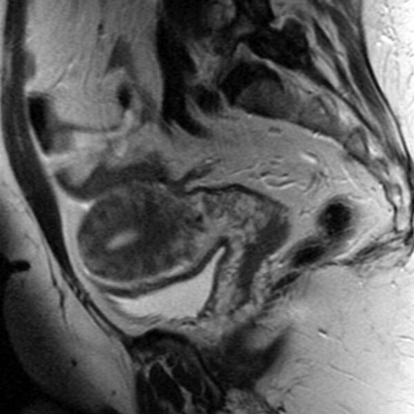 File:Adenomyosis of the uterus (Radiopaedia 9869-10437 Sagittal T2 6).jpg
