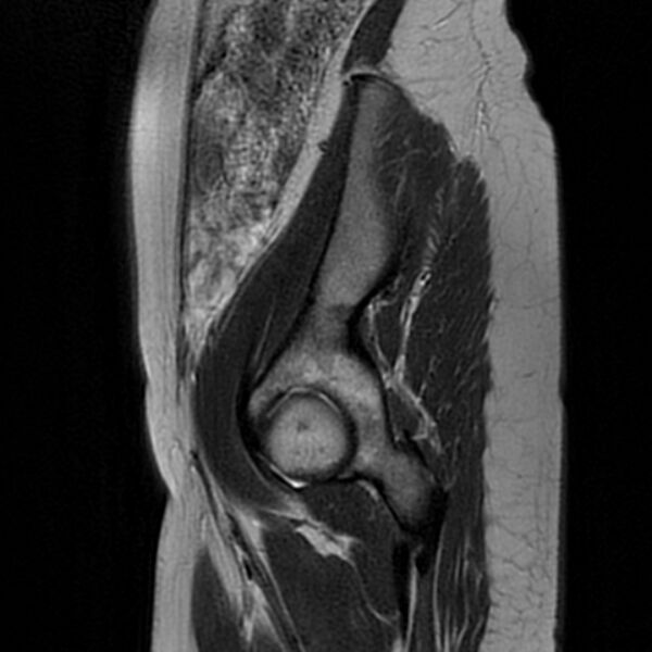 File:Adenomyosis within a septate uterus (Radiopaedia 69963-79981 Sagittal T2 2).jpg