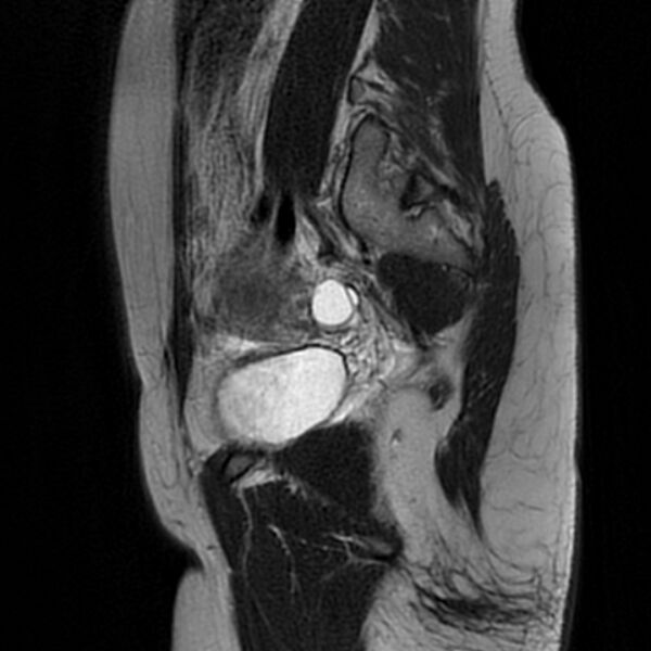 File:Adenomyosis within a septate uterus (Radiopaedia 69963-79981 Sagittal T2 8).jpg