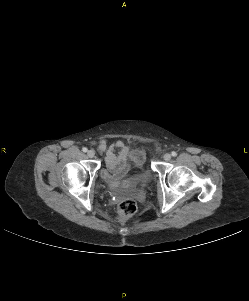 Adhesional small bowel obstruction (Radiopaedia 85402-101024 Axial C+ portal venous phase 272).jpg