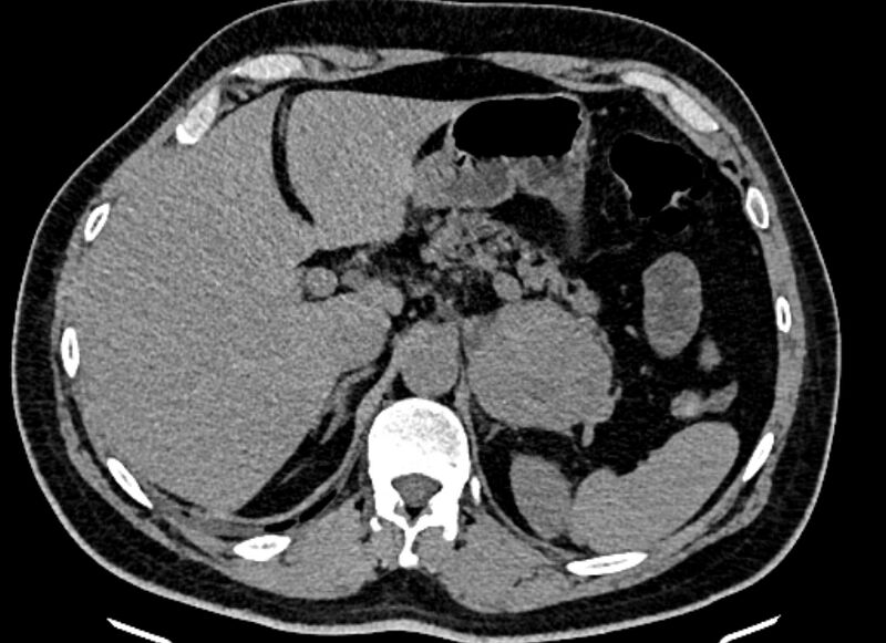 File:Adrenal metastases (Radiopaedia 73082-83791 Axial non-contrast 45).jpg