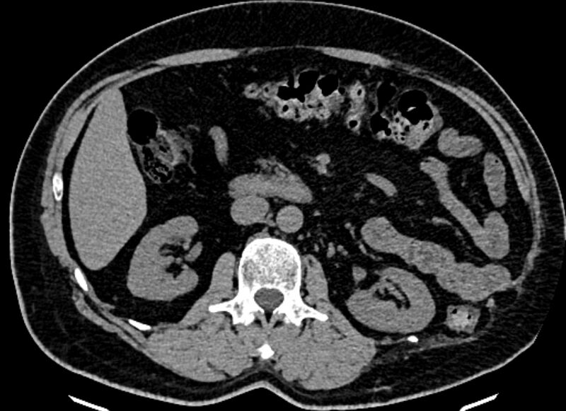 File:Adrenal metastases (Radiopaedia 73082-83791 Axial non-contrast 81).jpg
