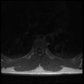Aggressive vertebral hemangioma (Radiopaedia 39937-42404 Axial T1 21).png